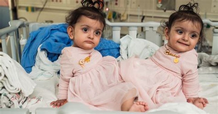 Bateson Conjoined Twins Are A ‘Miracle’ As Parents Share, Photos On Reddit