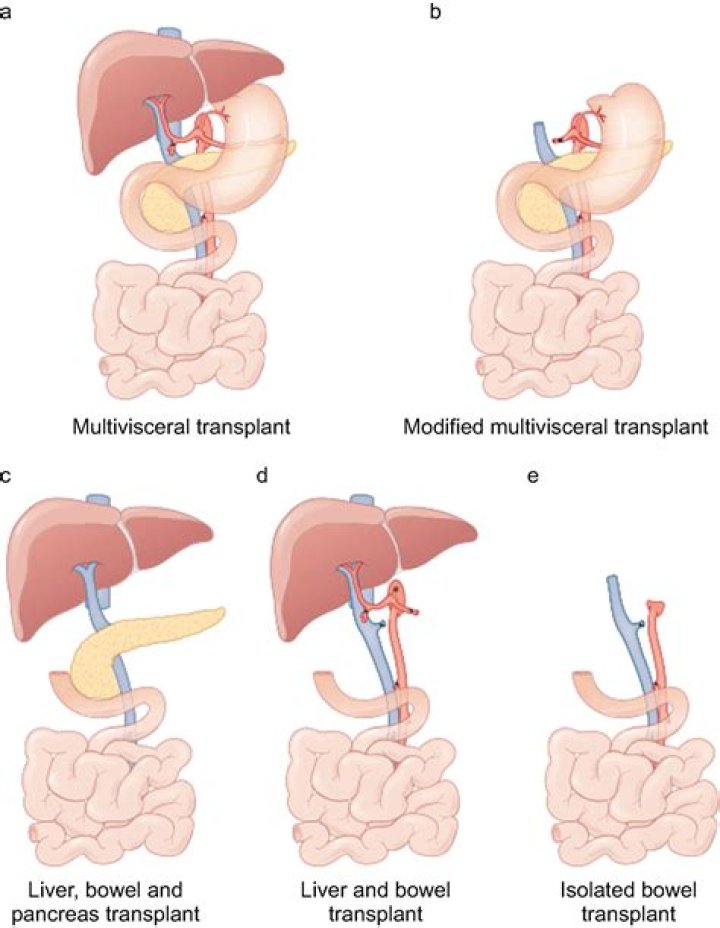 
Intestine Transplant Baby: Transplant In 13 Months Old Baby Emma, Who Are Her Parents? 
