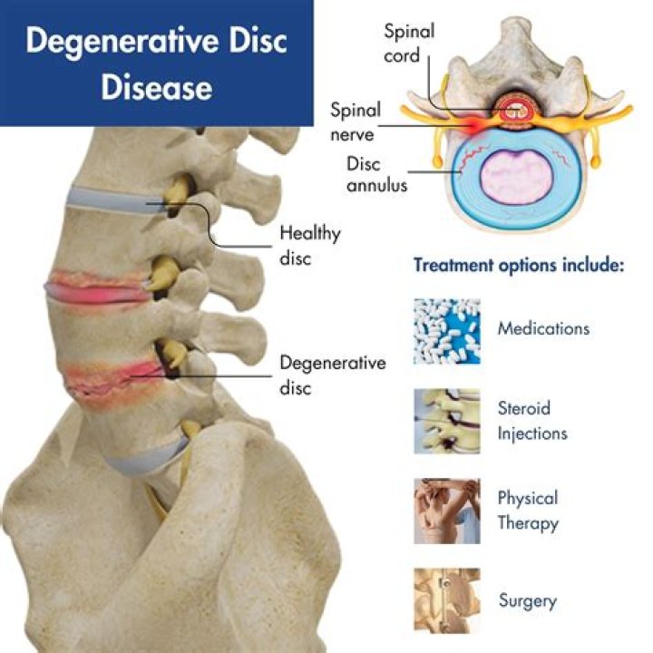 
Pen Medina Is Diagnosed With Degenerative Disc Disease 
