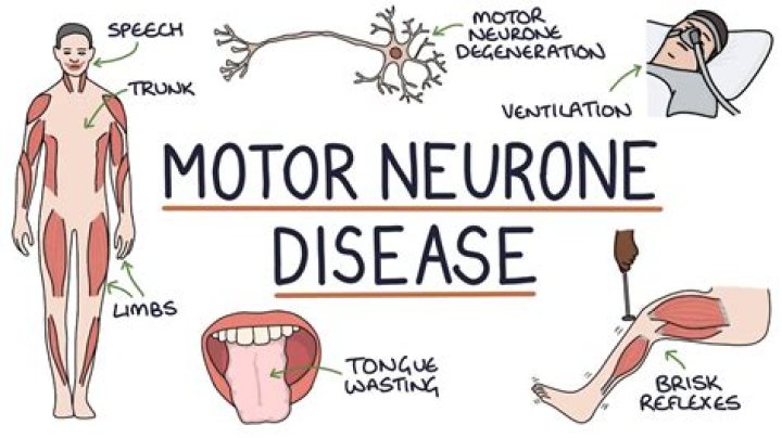 
Rob Burrow’s Illness Motor Neurone Disease And Health Update 2022 