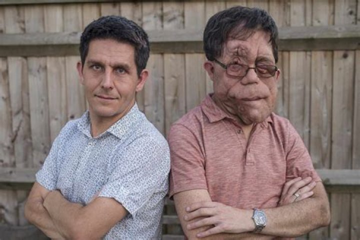 Who Is Adam Pearson’s Brother, Neil Pearson? Family Background Explored